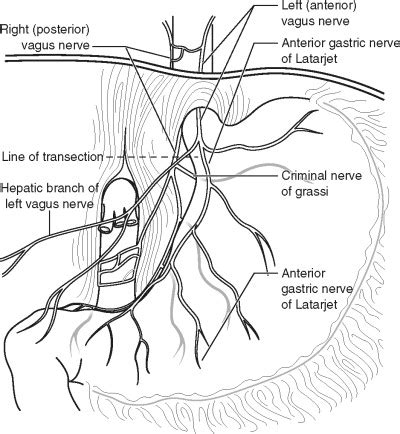 TRUNCAL VAGOTOMY | Abdominal Key