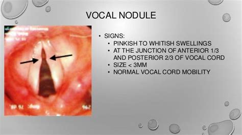 Benign lesions of larynx