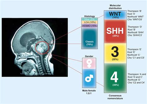 Medulloblastoma Cancer - Causes, Symptoms, Prognosis & Treatment