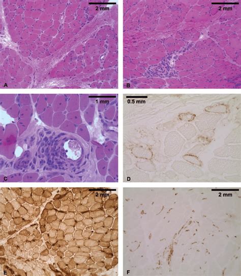 Muscle biopsy of patient #3. Representative images of patient #3\'s ...