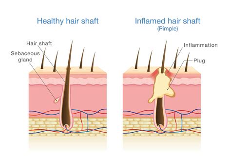 Rash On Arm Hair Follicles Diagram