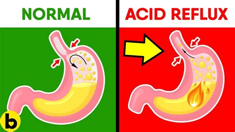 How Baking Soda can help with Acid Reflux & Heartburn | The Australian ...