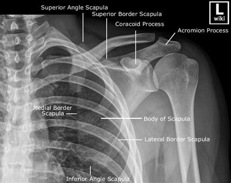 SCAPULA AP | Radiology imaging, Medical anatomy, Diagnostic imaging