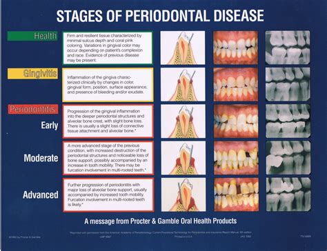 Stages of periodontal disease. #dentistry | Dental hygiene school, Dental hygiene student ...