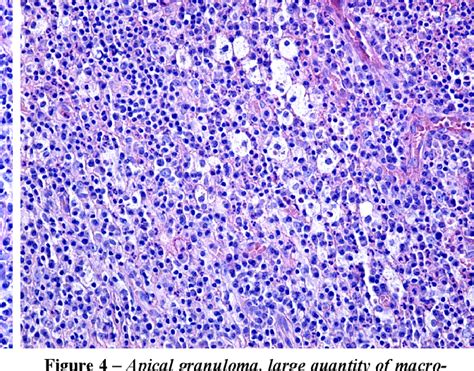 Periapical Granuloma Histology