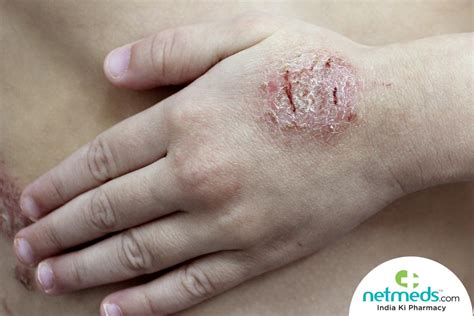 Discoid Eczema: Causes, Symptoms and Treatment