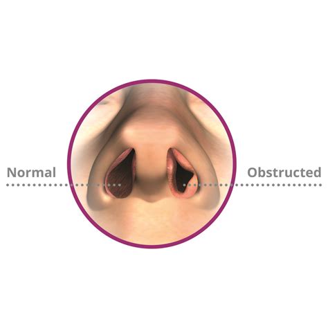 Nasal Obstruction - Adult & Pediatric Ent & Allergy, Hearing Aids & Audiology of The Woodlands