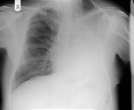 White lung: chronic obstructive pulmonary disease | The BMJ