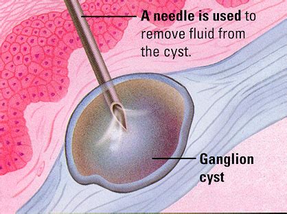 Treatment for Ganglion Cyst | 🏥Singapore Orthopaedic & Sports Medicine