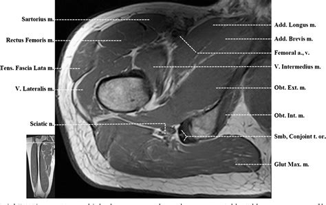 Figure 4 from Normal MR imaging anatomy of the thigh and leg. | Semantic Scholar