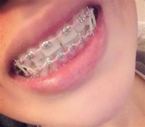 Braces #braces #braces | Braces colors, Brace face, Cute braces