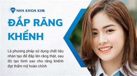 Đắp răng khểnh giá bao nhiêu? Phương pháp và thời gian sử dụng