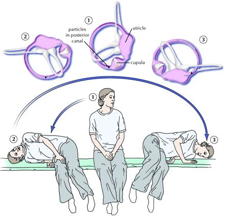 Benign paroxysmal positional vertigo (BPPV): โรคหินปูนในหูชั้นในหลุด | Vertigo treatment ...