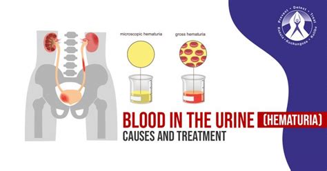 Blood in the Urine (Hematuria): Causes and Treatment | Regency Hospital