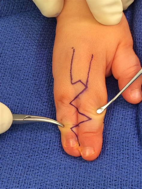 Ulnar Deficiency and Syndactyly | Congenital Hand and Arm Differences | Washington University in ...