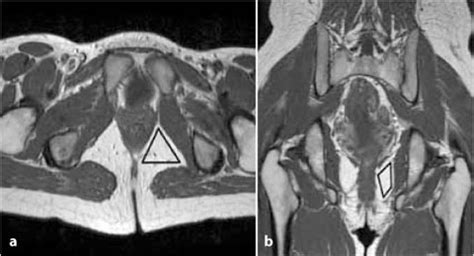 MRI Anatomy of the Anorectal Region | Radiology Key