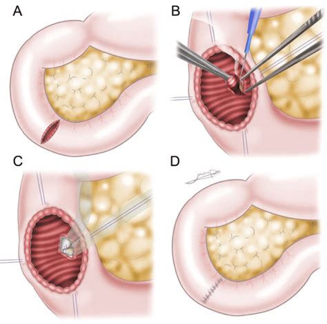 Operative technique for trasnduodenal ampullectomy (illustration). (a ...