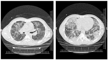 Acute Eosinophilic Pneumonia Due To Cocaine Inhalation | International ...