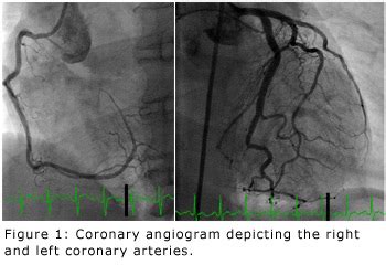 Alexandria Cath Lab | Cardiac Catheterization Procedure