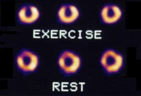 Thallium Heart Scan (Thallium Myocardial Perfusion Scan) - British Nuclear Medicine Society