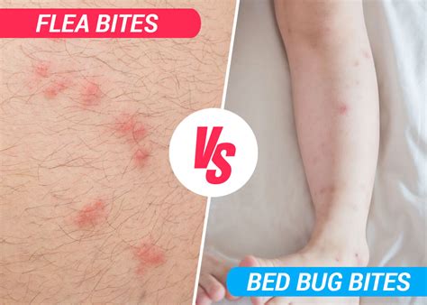 Flea Bed Bug Bites Difference