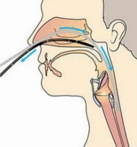 Nasendoscopy Procedure - ENT Clinic Sydney