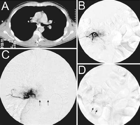 Illustrative case showing a metastasis of a renal cell carcinoma on the... | Download Scientific ...