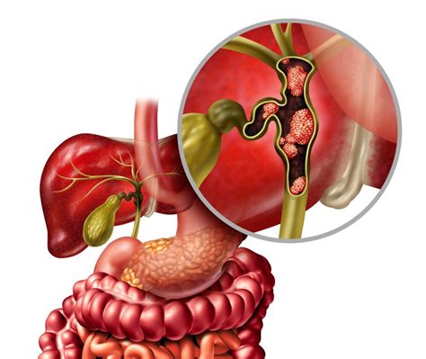 Bile Duct Cancer Symptoms and Treatment | Nexus Surgical