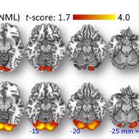 Effects of VS on brain glucose metabolism (absolute metabolic images ...