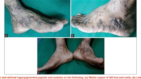 Figure 1 from Erythema elevatum diutinum in acquired immune deficiency syndrome: Can it be an ...