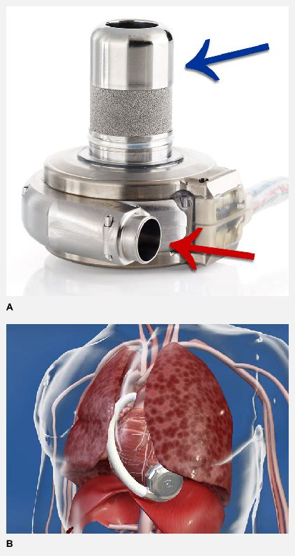 A: The HeartWare LVAD device with the tip of the device to be inserted... | Download Scientific ...