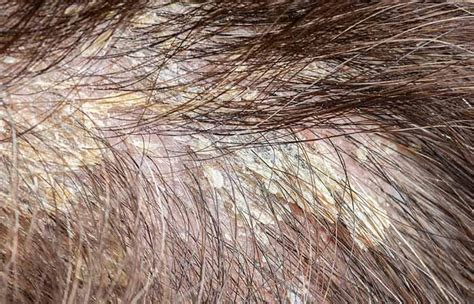 Scalp Buildup: Causes, Treatment, And Prevention