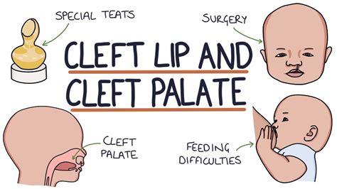 cleft palate repair post-op nursing care - francisca-bongartz