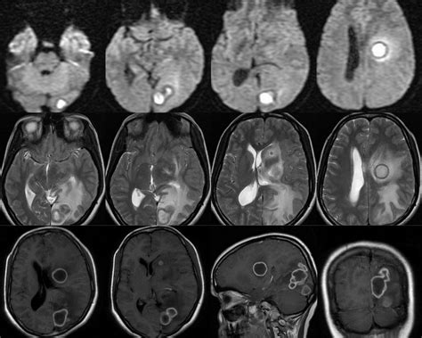 Dr Balaji Anvekar FRCR: Role of MRI Diffusion