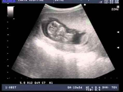 Ultrasound Pictures: Two Month Ultrasound Pictures