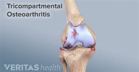 Knee Osteoarthritis Symptoms