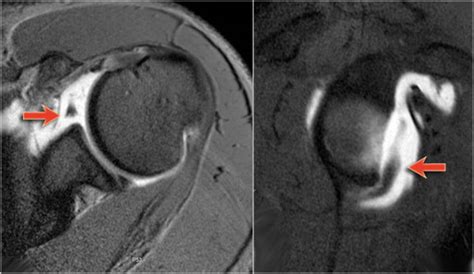 Mri Shoulder Labrum Tear