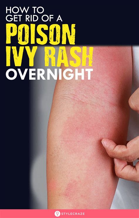 How To Get Rid Of Poison Ivy Rash In 1 Day