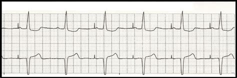 Float Nurse: EKG Rhythm Strip Quiz 100: Paced rhythms