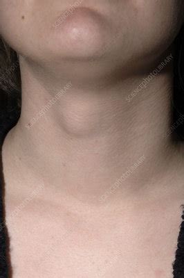 Thyroglossal cyst - Stock Image - M130/0892 - Science Photo Library