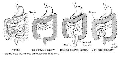 Seeking Healthy Life: What is an Ileostomy Surgery? – Types of an Ileostomy