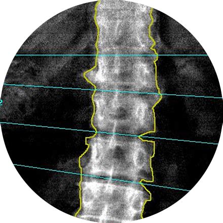 Bone Density Scan | RadNet