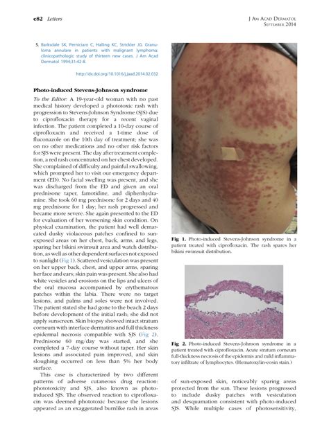 (PDF) Photo-induced Stevens-Johnson syndrome