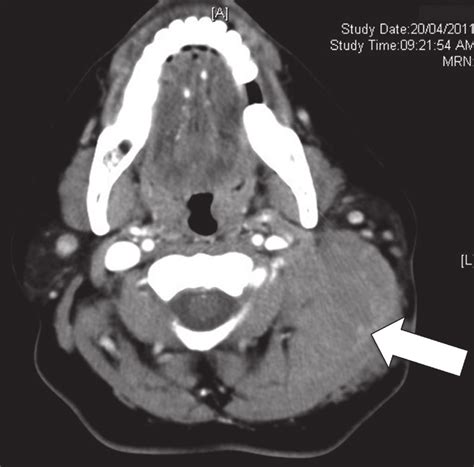 -Computed tomography scan of the neck showing a soft tissue mass at the ...