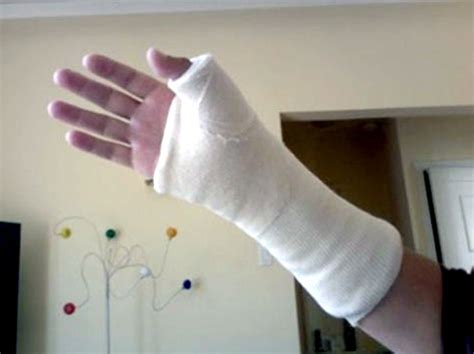 Cast Kit - Short Arm - Plaster - A-1 Medical Integration