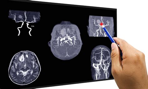 Brain Aneurysm Surgery: Purpose of Brain Aneurysm Surgery