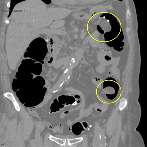 Lipoma CT - wikidoc