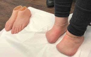 'DO YOU HATE THE LOOK OF YOUR FOOT AFTER AN AMPUTATION?' | Consulting Footpain