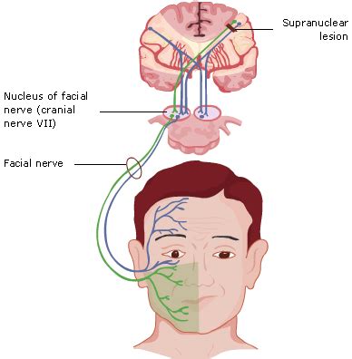 Facial Palsy - RCEMLearning