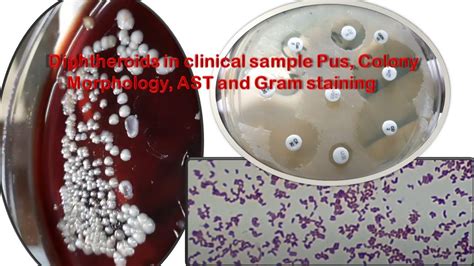 Diphtheroids in clinical sample Pus, Colony Morphology, AST and Gram staining - YouTube